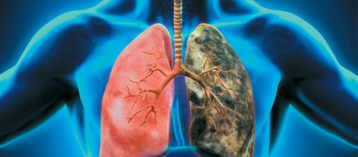 Αυτά είναι τα υπερτρόφιμα που μειώνουν κατά 33% τον κίνδυνο καρκίνου του πνεύμονα